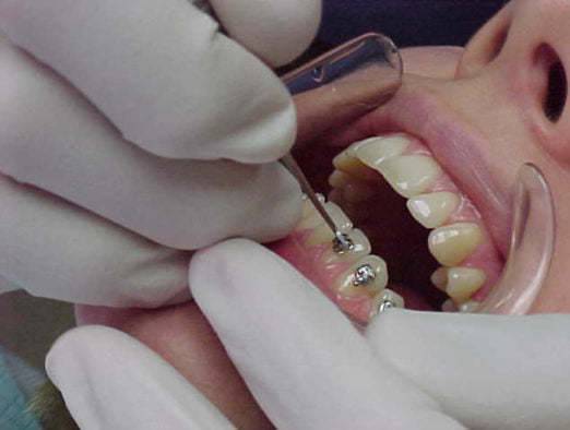 Как болят зубы с брекетами thumbnail